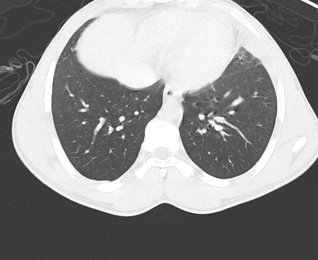 Arrow injury to the chest (Radiopaedia 75223-86321 Axial lung window 64).jpg