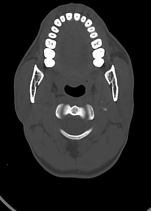 Arrow injury to the head (Radiopaedia 75266-86388 Axial bone window 32).jpg