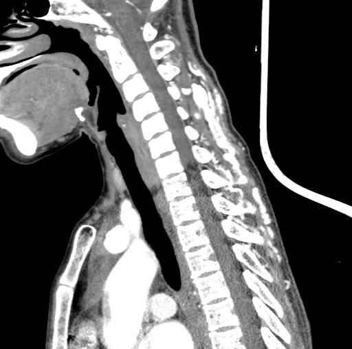 Arteriovenous malformation of the neck (Radiopaedia 53935-60062 C 63).jpg