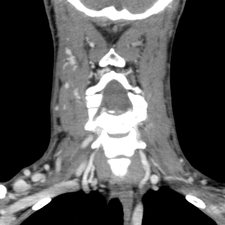 Arteriovenous malformation of the neck (Radiopaedia 53935-60062 D 17).jpg
