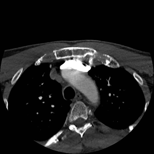 Artery of Percheron infarct (Radiopaedia 48088-52894 A 7).jpg