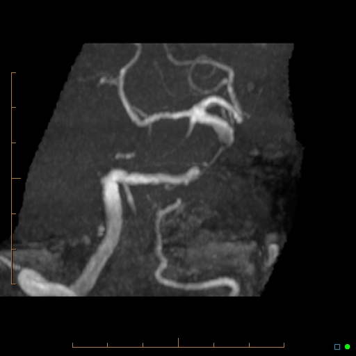 File:Artifactual basilar artery stenosis due to metallic stent (Radiopaedia 31206-31922 3D MIP 5).jpg