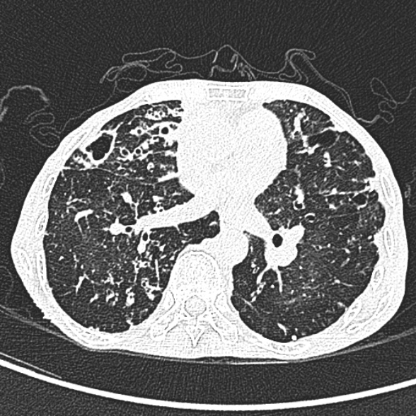File:Aspergilloma- with Monod sign (Radiopaedia 44737-48532 Axial lung window 150).jpg