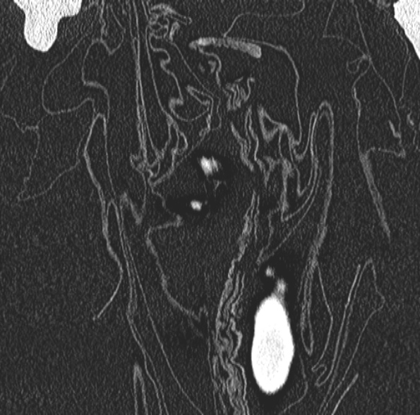 File:Aspergilloma- with Monod sign (Radiopaedia 44737-48532 Coronal lung window 98).jpg