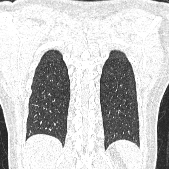 File:Aspergilloma (Radiopaedia 26223-26347 Coronal lung window 46).jpg