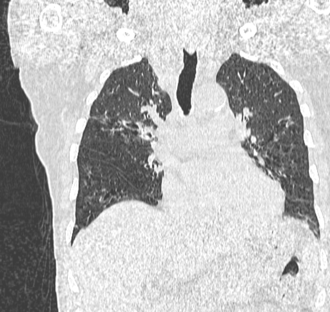 Aspergilloma (Radiopaedia 44592-48327 Coronal lung window 56).jpg
