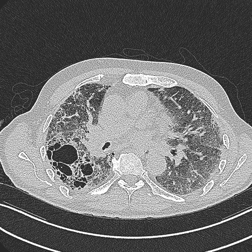 File:Aspergilloma on background pulmonary fibrosis (Radiopaedia 60942-68757 B 27).jpg