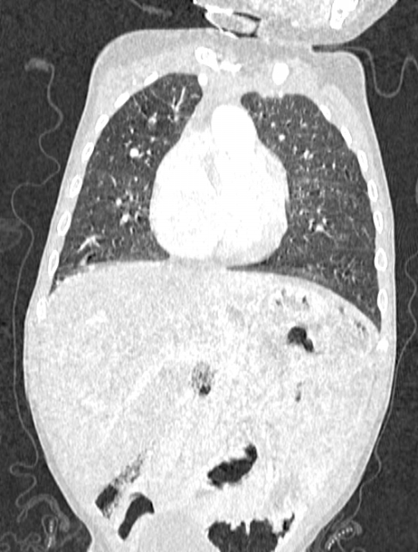 Asplenia syndrome (Radiopaedia 73083-83792 Coronal lung window 48).jpg