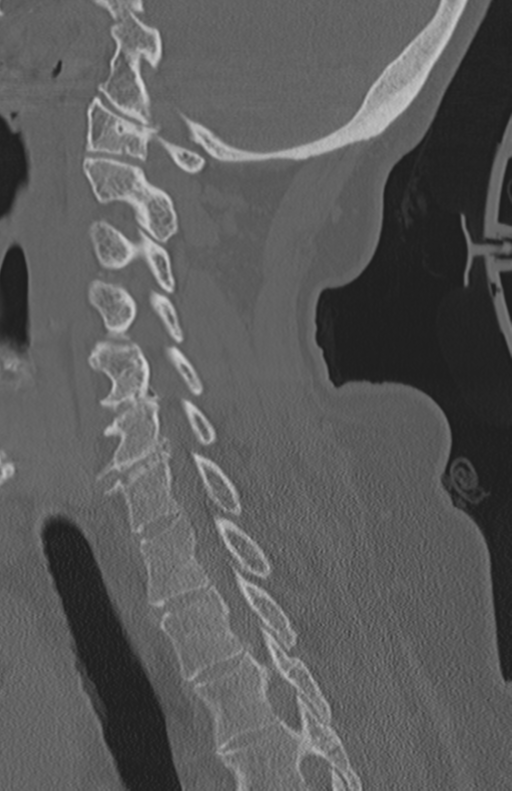 Atlanto-axial subluxation (Radiopaedia 36610-38176 Sagittal bone window 49).png