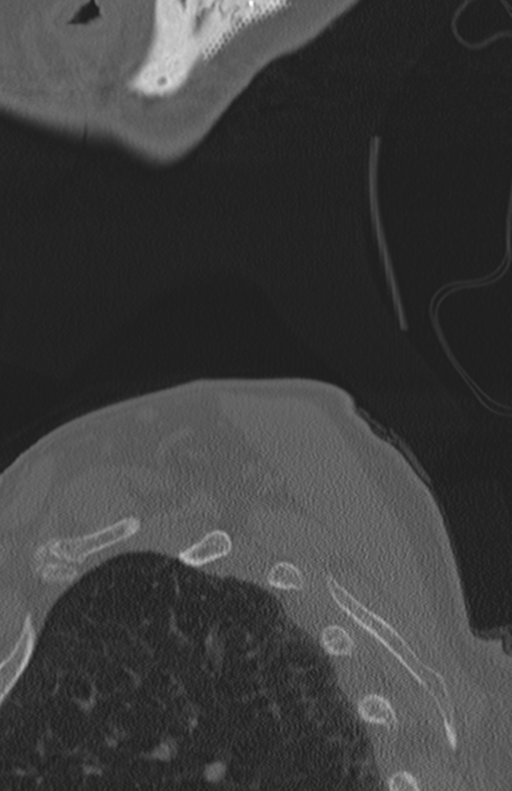Atlanto-axial subluxation (Radiopaedia 36610-38176 Sagittal bone window 81).png