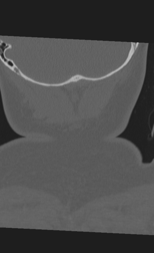 Atlanto-occipital dissociation (Radiopaedia 33848-35013 Coronal bone window 58).png