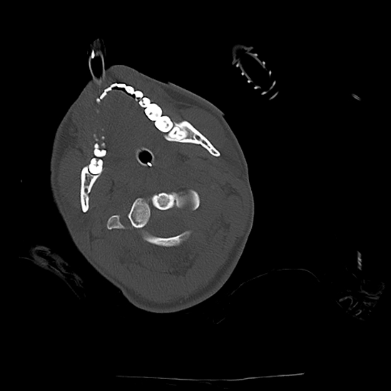 Atlanto-occipital dissociation (Traynelis type 1), C2 teardrop fracture, C6-7 facet joint dislocation (Radiopaedia 87655-104061 Axial bone window 25).jpg