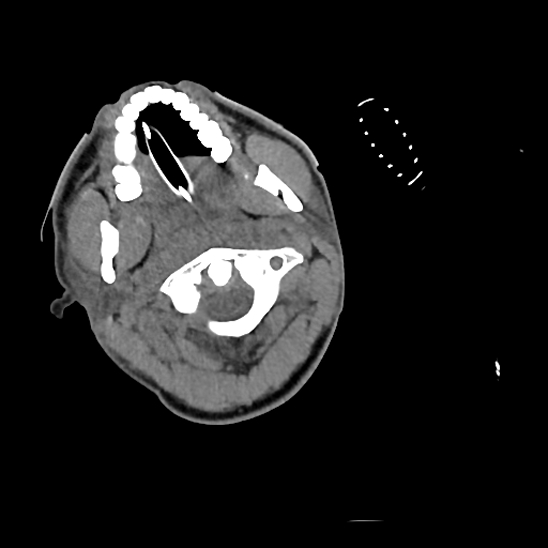File:Atlanto-occipital dissociation (Traynelis type 1), C2 teardrop fracture, C6-7 facet joint dislocation (Radiopaedia 87655-104061 Axial non-contrast 14).jpg