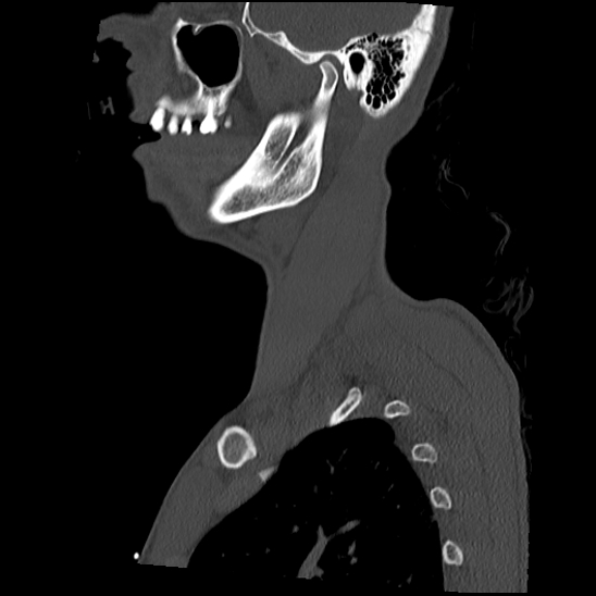 Atlanto-occipital dissociation (Traynelis type 1), C2 teardrop fracture, C6-7 facet joint dislocation (Radiopaedia 87655-104061 Sagittal bone window 9).jpg