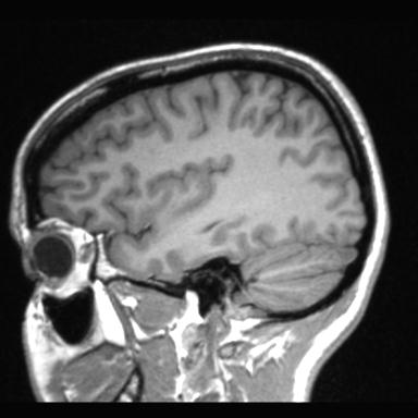 Atretic encephalocoele with inferior vermis hypoplasia (Radiopaedia 30443-31108 Sagittal T1 100).jpg