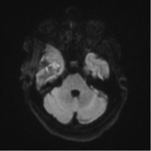 File:Atypical meningioma (WHO Grade II) (Radiopaedia 54742-60981 Axial DWI 36).png