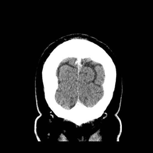 Atypical meningioma (WHO grade II) with brain invasion (Radiopaedia 57767-64728 Coronal C+ 58).png