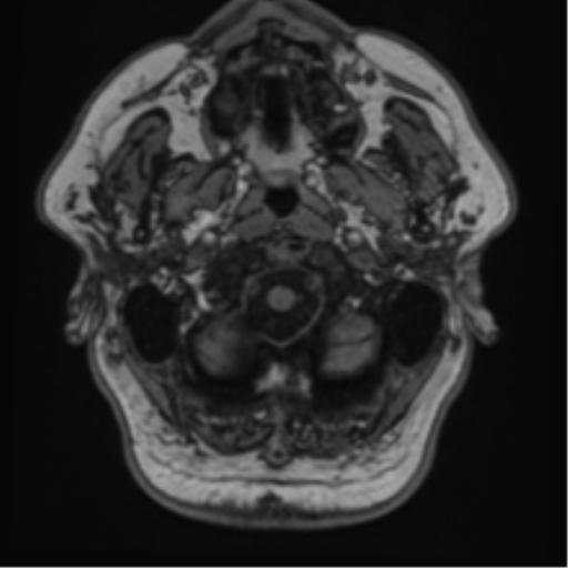 File:Atypical meningioma (WHO grade II) with brain invasion (Radiopaedia 57767-64729 Axial T1 2).png