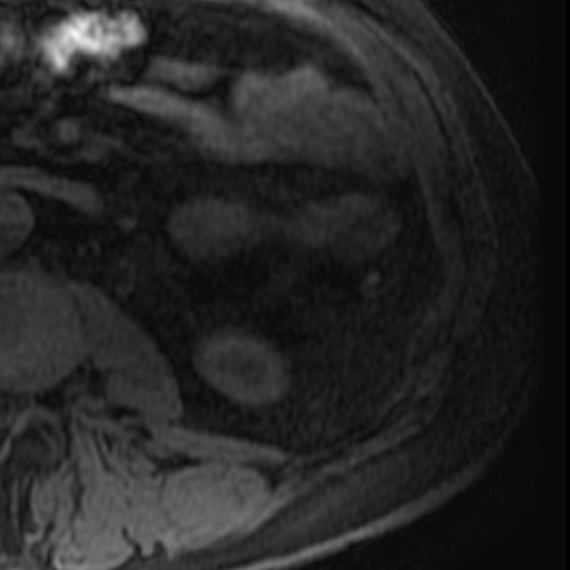 File:Atypical renal cyst on MRI (Radiopaedia 17349-17046 Axial T1 fat sat 29).jpg