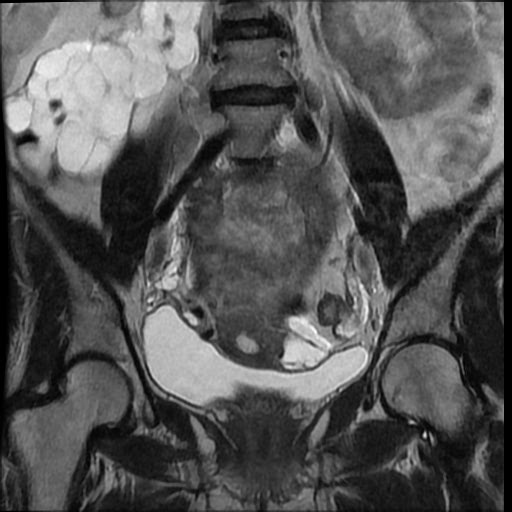 File:Atypical retroperitoneal lymphocoeles with large leiomyoma of uterus (Radiopaedia 32084-33027 Coronal T2 20).jpg