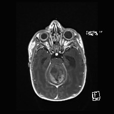 File:Atypical teratoid rhabdoid tumor (prenatal US and neonatal MRI) (Radiopaedia 59091-66388 Axial T1 C+ 22).jpg