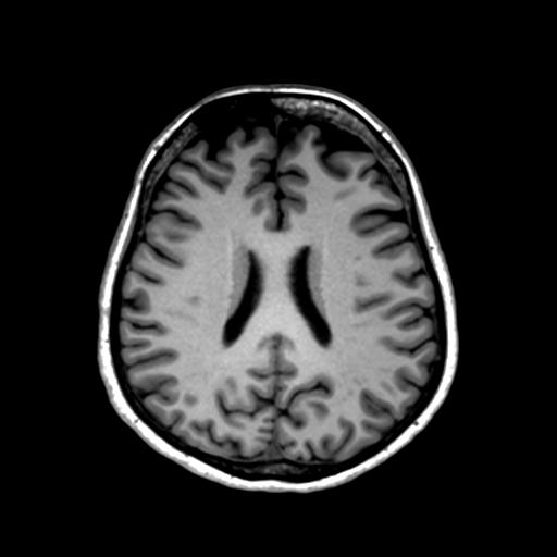 Autoimmune limbic encephalitis (Radiopaedia 30363-31005 T1 Axial 1mm 96).jpg