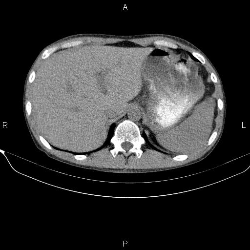 Autoimmune pancreatitis (Radiopaedia 84925-100431 Axial non-contrast 14).jpg