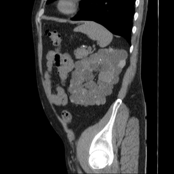 File:Autosomal dominant polycystic kidney disease (Radiopaedia 36539-38101 D 63).jpg
