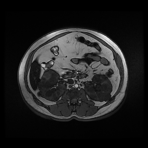 File:Autosomal dominant polycystic kidney disease (Radiopaedia 50259-55611 Axial 2D Dual Echo 45).jpg