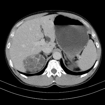 Autosomal dominant polycystic kidney disease (Radiopaedia 66349-75582 B 20).jpg