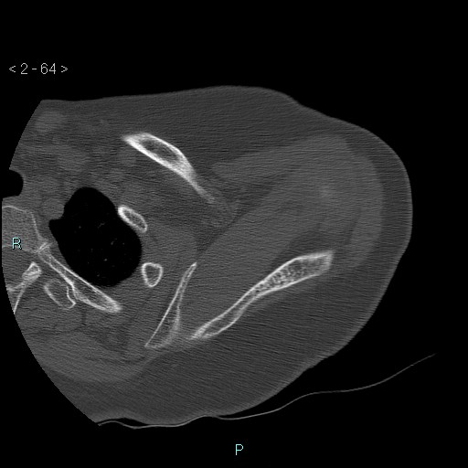 File:Avascular necrosis of the shoulder - Cruess stage I (Radiopaedia 77674-89887 Axial bone window 16).jpg