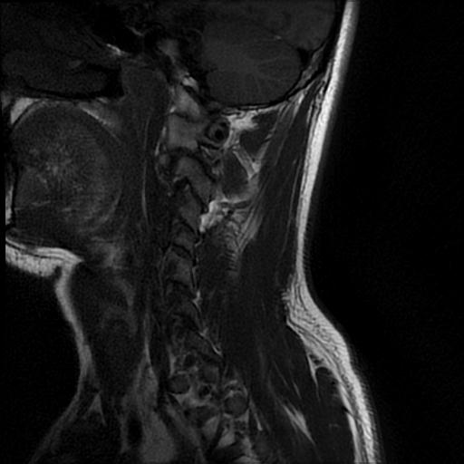 File:Axis fracture - MRI (Radiopaedia 71925-82375 Sagittal T1 9).jpg