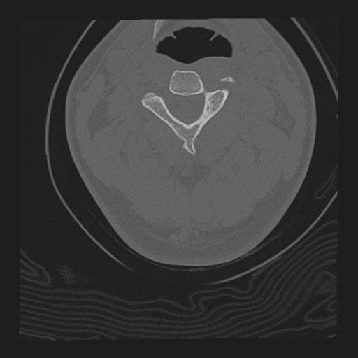 File:Axis peg fracture (type 3) and atlas lateral mass (type 4) fracture (Radiopaedia 37474-39324 Coronal bone window 1).png