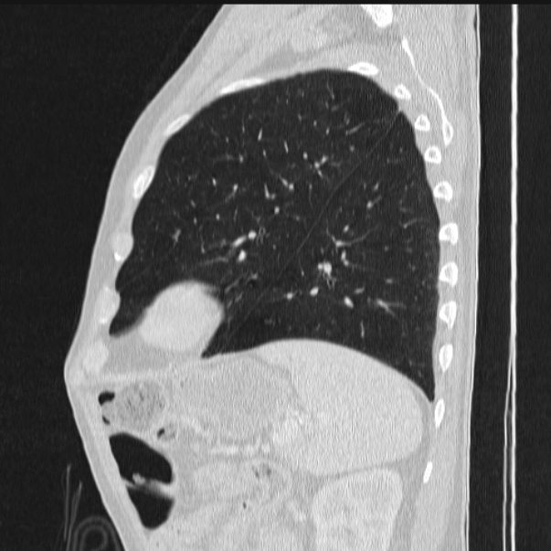 Azygos lobe (Radiopaedia 38259-40275 lung window 77).jpg