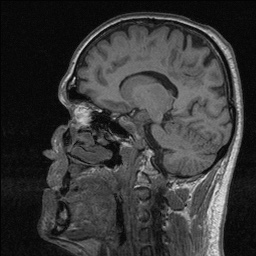 Balo concentric sclerosis (Radiopaedia 50458-55940 Sagittal T1 68).jpg