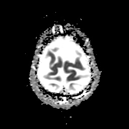 File:Balo concentric sclerosis (Radiopaedia 53875-59982 Axial ADC 23).jpg