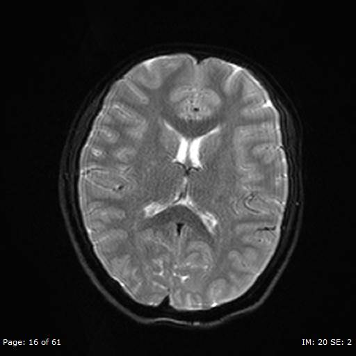 Balo concentric sclerosis (Radiopaedia 61637-69636 Axial DWI 16).jpg