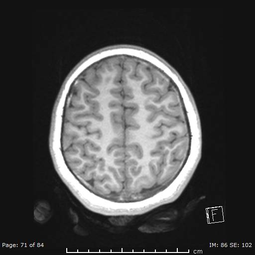 Balo concentric sclerosis (Radiopaedia 61637-69636 Axial T1 71).jpg