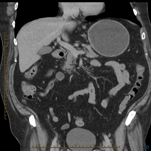 File:Bariatric balloon causing gastric outlet obstruction (Radiopaedia 54449-60672 B 26).jpg
