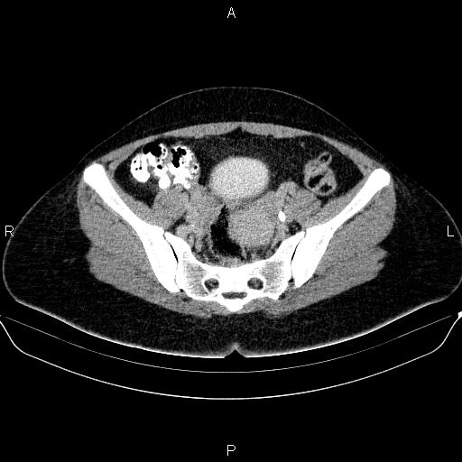 Bartholin gland cyst (Radiopaedia 62635-70930 C 31).jpg
