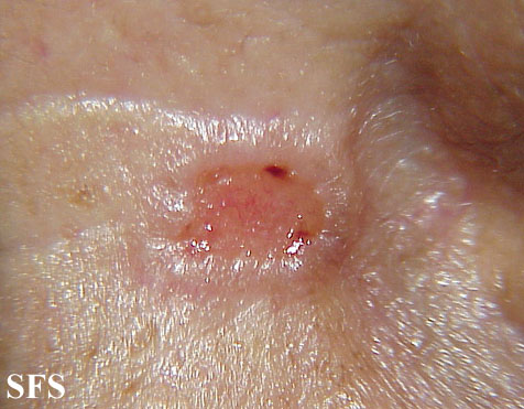 Basal Cell Carcinoma (Dermatology Atlas 66).jpg