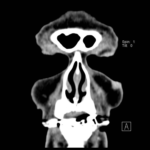 File:Basal cell carcinoma (periocular with orbital invasion) (Radiopaedia 30974-31672 Coronal Postcontrast 3).jpg