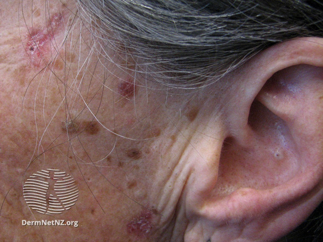 Basal cell carcinoma affecting the face (DermNet NZ lesions-bcc-face-0728).jpg