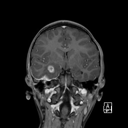 Base of skull rhabdomyosarcoma (Radiopaedia 32196-33142 I 38).jpg