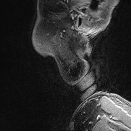 Base of tongue squamous cell carcinoma (Radiopaedia 31174-31884 F 171).jpg
