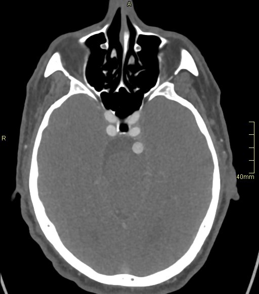 File:Basilar artery aneurysm (Radiopaedia 56261-62932 A 65).jpg