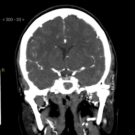 Basilar artery thrombosis (Radiopaedia 16260-15944 B 24).jpg