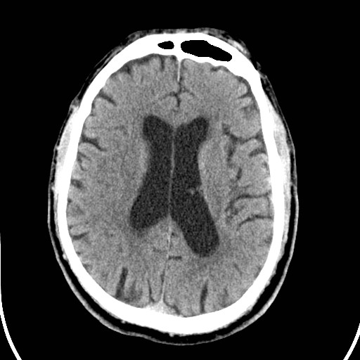 File:Basilar artery thrombosis (Radiopaedia 26986-27162 Axial non-contrast 20).jpg