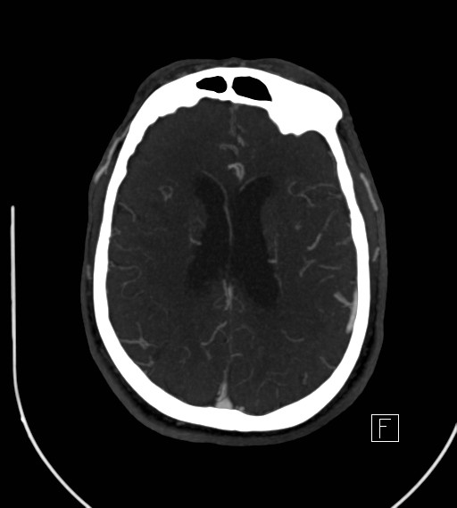 Basilar artery thrombosis (Radiopaedia 26986-27163 A 57).jpg