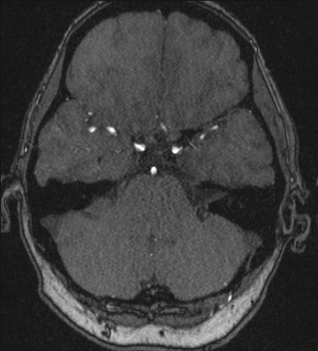 Basilar tip aneurysm (Radiopaedia 26504-26632 MRA 63).jpg